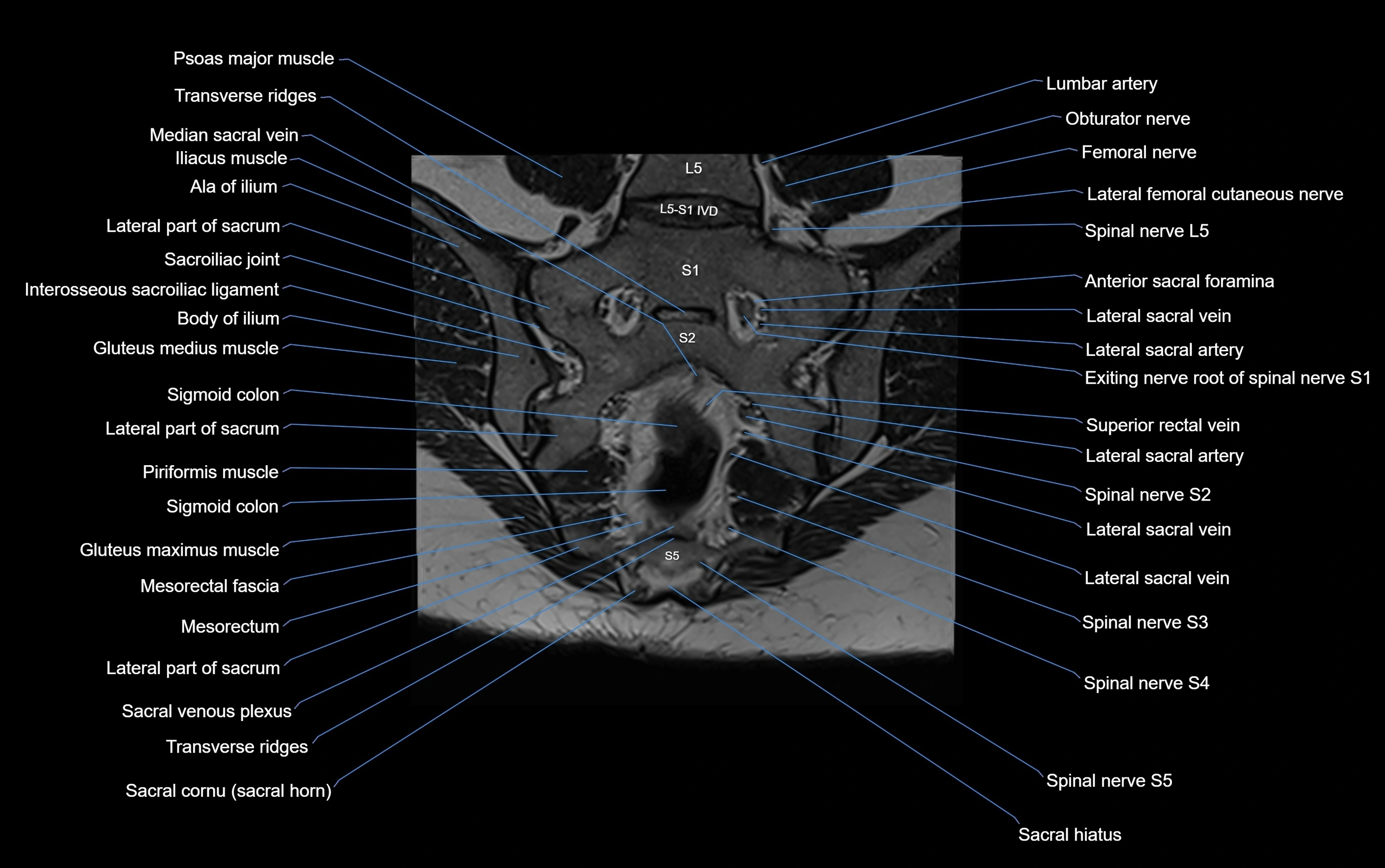MRI sacroiliac joint coronal cross sectional anatomy  radiology  image-img-00001-00018.webp
